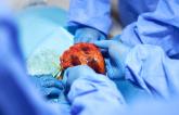 Donor Hearts Fare Better With Novel Method After Circulatory Death 