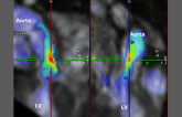 Four-Dimensional Flow CMR Shows Promise in Aortic Stenosis