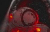 What’s the Damage With Long COVID Advanced Imaging Reveals Clues