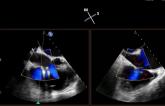 CMS Agrees to Reimburse Tricuspid TEER