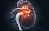 CMS Issues Proposed Coverage Decision for Renal Denervation