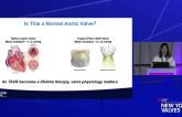 Beyond the Gradient: Restoring Native Flow with TAVR for Enhanced LV Recovery