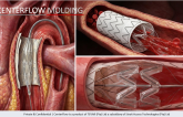 Strait Access Technologies Achieves First-in-Human Milestone with CenterFlow® Following TEVAR