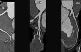 Single Heartbeat CCTA Acquisition Suffices in Many Young, Low-risk Patients