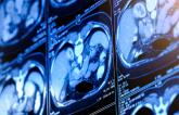 CAC Derived From Nongated CT Can Accurately Predict CV Risk