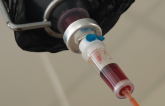 Correcting Anemia With IV Iron Before Cardiac Surgery Pays Dividends