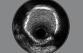Quality-Improvement Initiative Spurs Imaging-Guided PCI Use