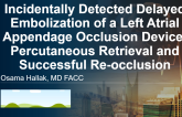 Incidentally Detected Delayed Embolization of a Left Atrial Appendage Occlusion Device Percutaneous Retrieval and Successful Re-occlusion​