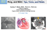 Transcatheter Mitral Valve-in-Valve, Ring, and MAC: Tips, Tricks, and Pitfalls