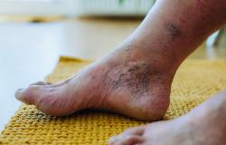 Amputation Risks Higher After Revascularization in Younger vs Older PAD Patients