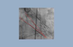 Underexpanded Acurate Valves Come With Higher Stroke Risk, Study Confirms