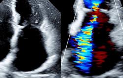 TEER May Surpass Medical Therapy in High-risk Atrial FMR Patients