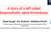 Thromboaspiration of a Left-Sided Bioprosthetic Valve Thrombosis by a Mini-Invasive Access: A Novel Procedure to Alleviate the Risks of Thrombolysis, Angiovac and Redo-Surgery