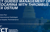 TCT 1263:  OCT Guided Management of Neocarina With Thrombus at LCX Ostium