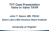 Case Presentation 1: Optimizing ViV TAVR With Bioprosthetic Valve Failure in a Stented Surgical Valve