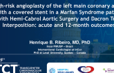 TCT 1466: High-Risk Angioplasty of the Left Main Coronary Artery With a Covered Stent in a Marfan Syndrome Patient With Hemi-Cabrol Aortic Surgery and Dacron Tube Interposition: Acute and 12-Month Outcomes