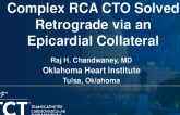TCT 1163: Complex RCA CTO Solved Retrograde via an Epicardial Collateral