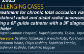 TCT 853: A treatment for chronic total occlusion via ipsilateral radial and distal radial accesses using a 6F guide catheter with a 3F diagnostic catheter