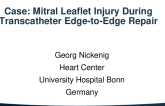 Case: Mitral Leaflet Injury During Transcatheter Edge-to-Edge Repair
