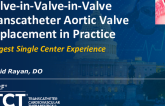 TCT 925: Valve-in-Valve-in-Valve Transcatheter Aortic Valve Replacement in Practice: Largest Single Center Experience