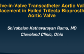 TCT 710: Valve-in-Valve Transcatheter Aortic Valve Replacement in Failed Trifecta Bioprosthetic Aortic Valve