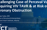 TCT 1423: Challenging Case of a Failed Perceval Valve Requiring ViV TAVR & at Risk of Coronary Obstruction