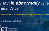 TCT 1441: TAVI in Abnormally Canted Surgical Valve