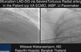 TCT 1094: Calming the VF Storm With Stellate Ganglion Block and PCI Bifurcation LAD-DG via Tortuous Radial Artery in Inferior Wall STEMI S/P VA ECMO, IABP, IJ Pacemaker