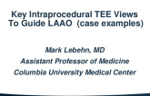 Key Intraprocedural TEE Views to Guide LAAO (case examples)