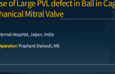 TCT 961: A case of large PVL defect in ball in cage mechanical mitral valve