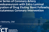 TCT 358: Case Series of Coronary Artery Pseudoaneurysm With Extra Luminal Migration of Drug Eluting Stent Following Percutaneous Coronary Intervention