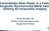 Transcatheter Redo Repair of a Failed Surgically Reconstructed Mitral Valve Using 4D Intracardiac Imaging 