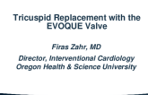 Case Presentation 2: Tricuspid Replacement with the Evoque Valve