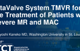 AltaValve TMVR System for Patients With Severe Mitral Regurgitation and Mitral Annular Calcification