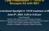 Case Presentation 1: TAVR in Bicuspid AS with BEV
