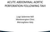 Acute Abdominal Aortic Perforation Following TAVI