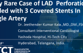 TCT 1422: Very Rare Case of LAD Type V Perforation Sealed With 3 Covered Stents in Single Artery