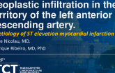 TCT 1221: Neoplastic Infiltration in the Territory of the Left Anterior Descending Artery: An Etiology of Acute Myocardial ST Elevation Myocardial Infarction