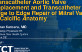 TCT 1278: Transcatheter Aortic Valve Replacement and Transcatheter Edge to Edge Repair of Mitral Valve in Calcific Anatomy