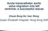 Acute Transcatheter Aortic Valve Migration Into Left Ventricle: A Successful Rescue