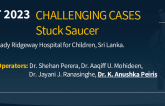 TCT 920: Stuck Saucer: A Rare Coplication of Atrial Septal Occluder intervention