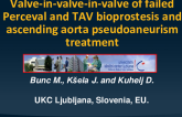 TCT 917: Valve-in-valve-in-valve of failed Perceval and TAV bioprostesis and ascending aorta pseudoaneurism treatment