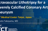 TCT 1123: Intravascular Lithotripsy for a Severely Calcified Coronary Artery Aneurysm