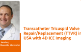 Transcatheter Tricuspid Valve Repair (TTVR) in USA with 4D ICE Imaging