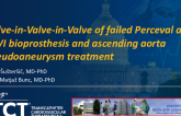 TCT 1096: How to Treat an Ascending Aorta Pseudoaneurysm and Failed Valve-in-Valve TAVI?