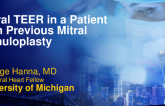 Mitral TEER for Severe Mitral Regurgitation After VT Ablation With Ruptured Chord in a Patient With Previous Mitral Annuloplasty
