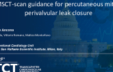 TCT 619: MSCT-Scan Guidance for Percutaneous Mitral Perivalvular Leak Closure