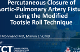 TCT 1228: Percutaneous Closure of Aortic-Pulmonary Artery Fistula Using the Tootsie Roll Technique