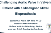 A Challenging Aortic Valve in Valve in a Patient With a Misaligned Mitral Bioprosthesis