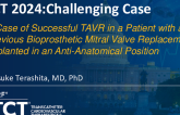 TCT 1171: A Successful Transcatheter Aortic Valve Replacement in a Patient After Previous Bioprosthetic Mitral Valve Replacement Implanted With Anti-Anatomical Position